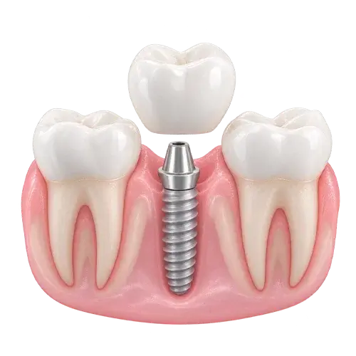 Implante dental unitario con corona