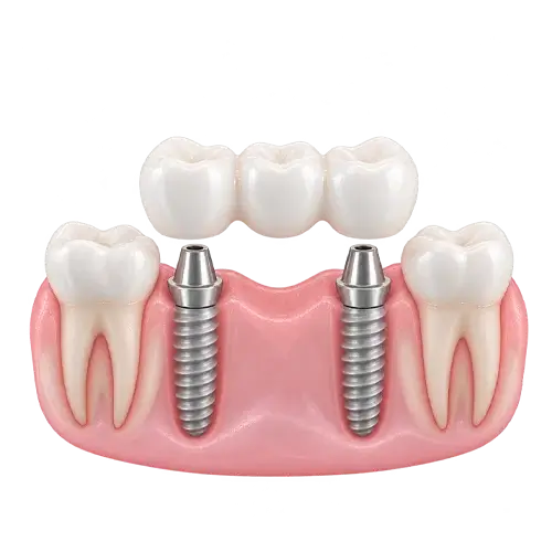 Puente dental sobre dos implantes